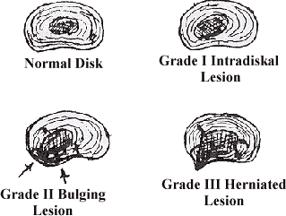 Cut-away of normal and damaged disks.