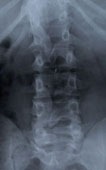 X-Ray of Damaged Spine (3954 bytes)