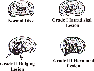 Diskal Lesions illustration