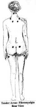 Illustration of the posterior view of a woman with trigger points indicated 
							with bullets.